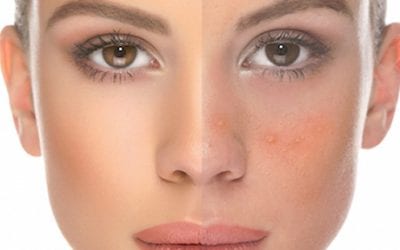 Rosacea Treatment Leeds
