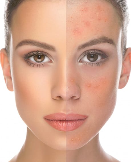 Rosacea Treatment Leeds