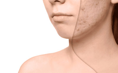 Acne Scar Treatment Leeds