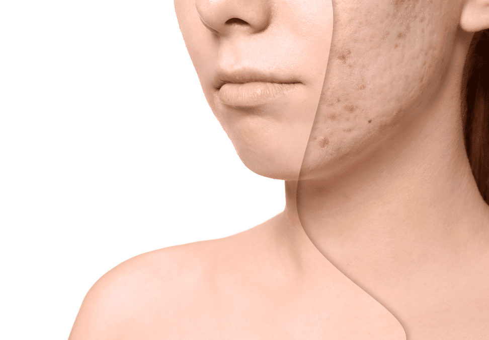 Acne Skin Care with Medifine, Leeds