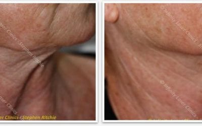 Skin Tightening Laser, Leeds
