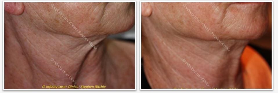 Skin Tightening Laser, Leeds