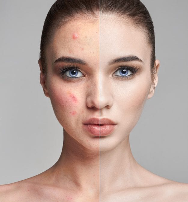 Teen Acne vs Adult Acne