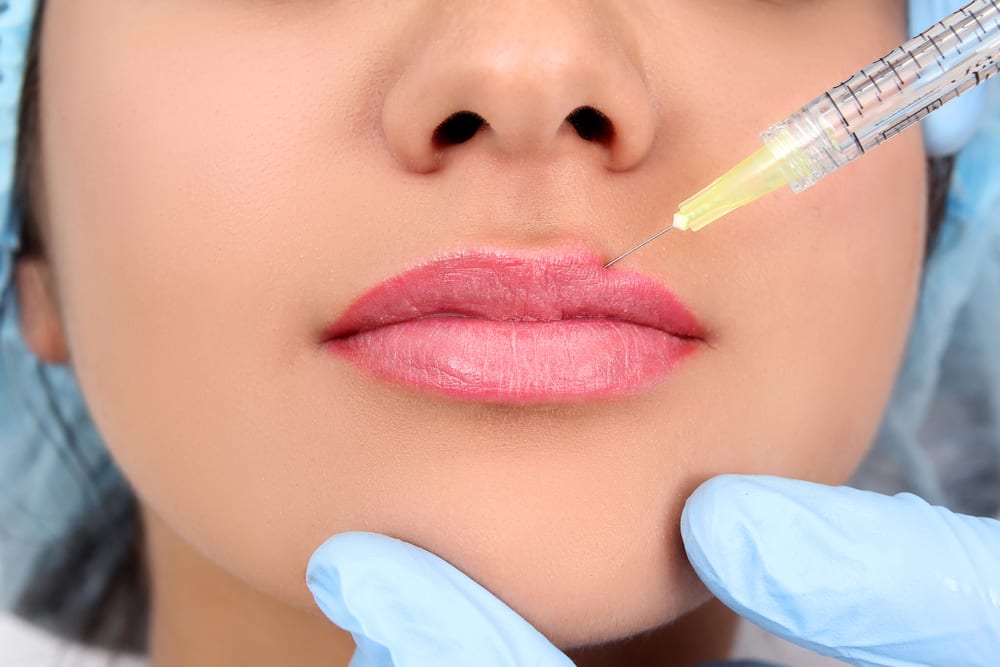 Lip Filler Leeds @ Medifine Aesthetics