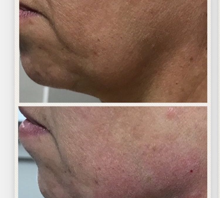 Jawline and Jowls Dermal Filler Treatment Leeds