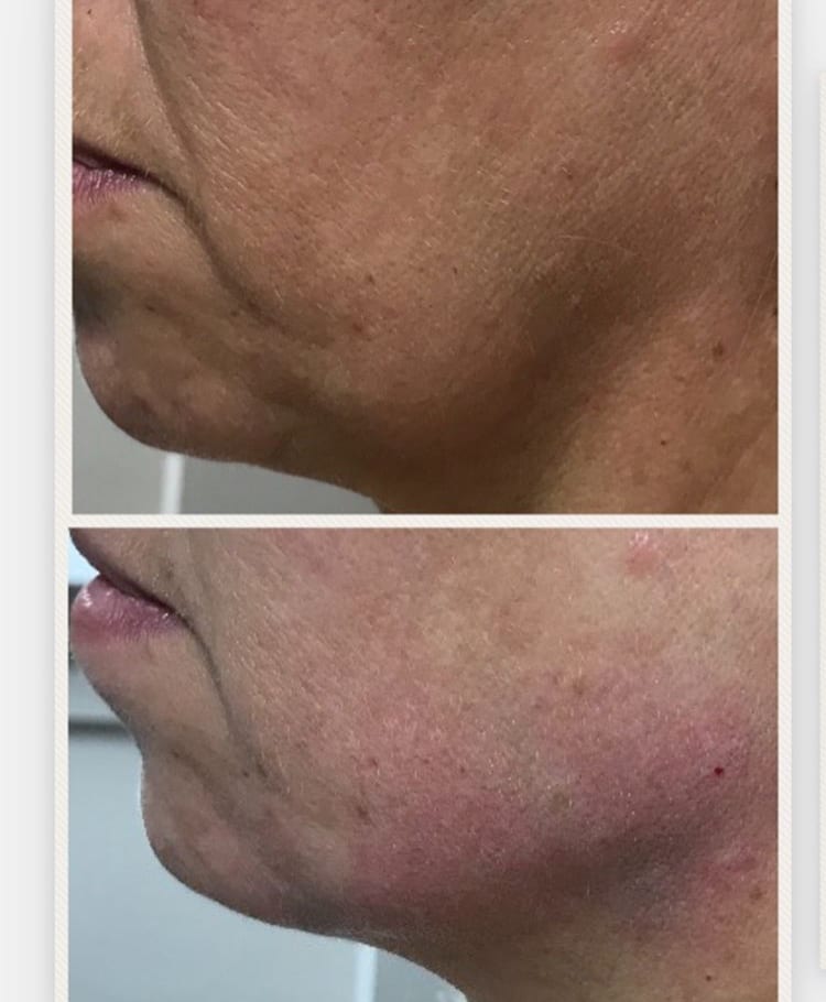 filler jawline jowls treatment dermal before leeds form consultation