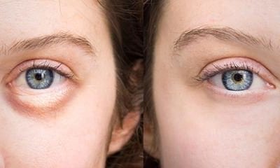 Puffy Eyes and How To Treat Them