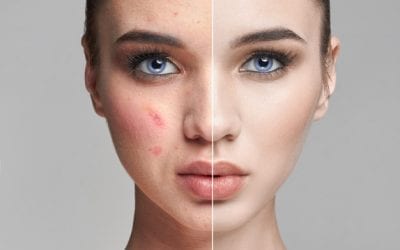 Acne Myths