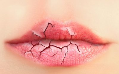 Winter Tips for taking care of the your lips