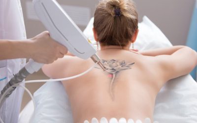 Tattoo Removal Laser,  Leeds