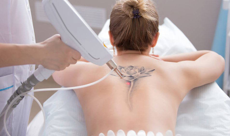 Tattoo Removal Laser,  Leeds