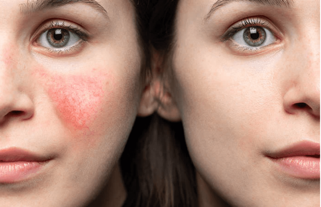 Rosacea and The Truth