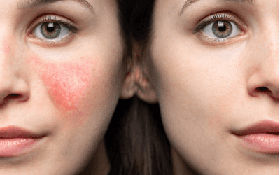 Rosacea and The Truth