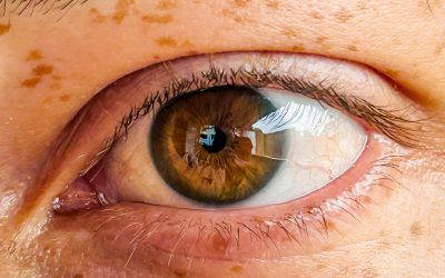 Skin Pigmentation : What it is, Causes, & Treatment